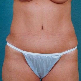 Tummy Tuck after 313076