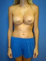 Revision Breast Surgery after 356591