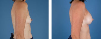 Breast Augmentation 349398