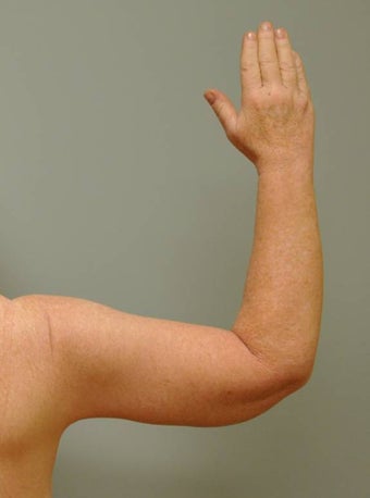 Arm Lift (Brachioplasty) after 465746