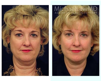 Facial Rejuvenation - Neck Lift before 395191