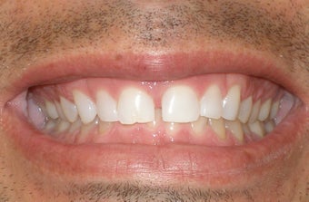 Veneers before 254583
