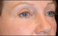 Eyelid Surgery after 373477