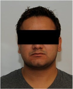 Smartlipo Neck after 123629