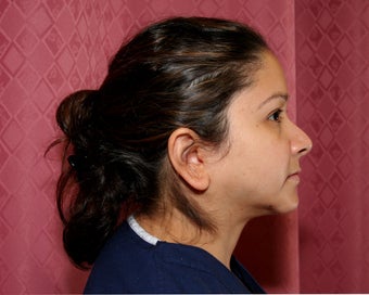 liposuction of neck & jaw line for women in Los Angeles 583586