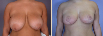 Breast Reduction & Lift before 270049