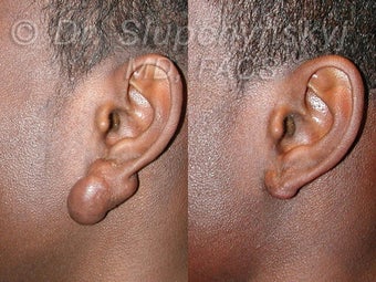 Keloid Removal before 563912