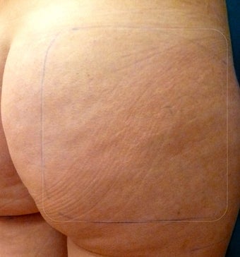 Cellulaze before 582363