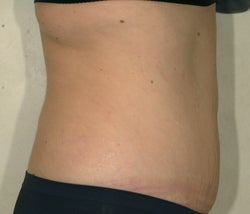 Liposuction and Tummy Tuck after 87087
