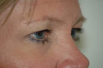Forehead Lift 434857