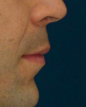 Lip Lift 635462