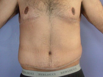 After Weight Loss after 280818