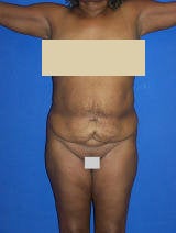 Massive Weight Loss Surgery before 131805