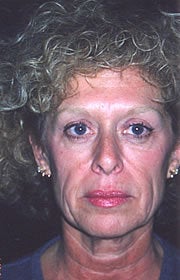 Face-neck Lift, SMAS elevation, LiveFill, Cheek Lift, and Upper Blepharoplasty before 83383
