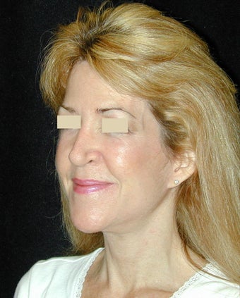 Facelift / Necklift after 103849