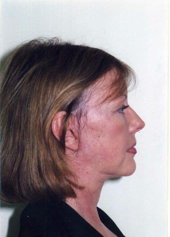 Neck Lift after 215151