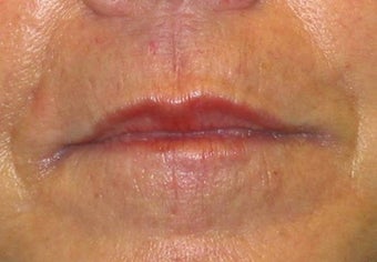 Juvederm effacement of perioral lines after 84413