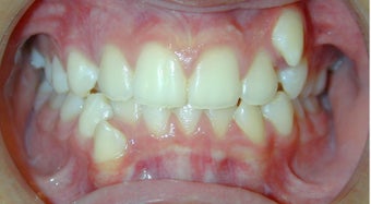 Teen Orthodontic Treatment (case #1BG) before 224559