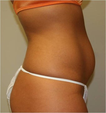 Smart Lipo Abdomen Side View before 109299