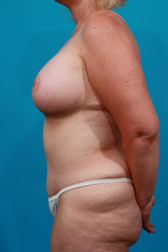 Mommy Makeover after 207552