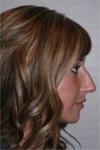 Rhinoplasty before 442949