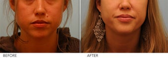 Mole Removal before 291718