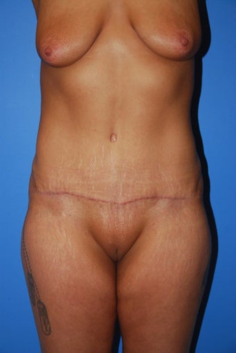 Abdominoplasty after 342442