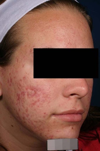 Acne laser treatment with PDT after 136707