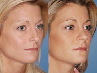 Revision rhinoplasty 334284