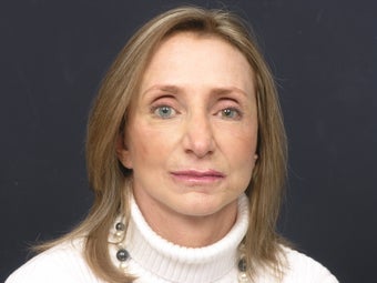 Facial rejuvenation after 140846