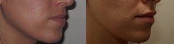 Lip Enhancement after 450121