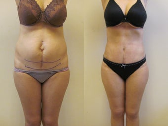 Tummy tuck before 222614