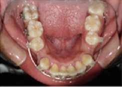 Braces and Extraction 349028