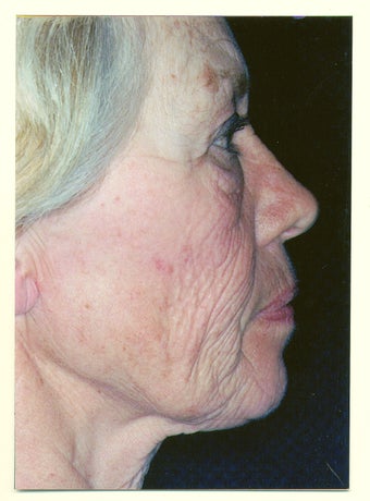 Facelift before 257849