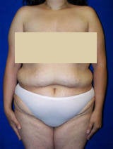 Extended Tummy Tuck (abdominoplasty) before 128663