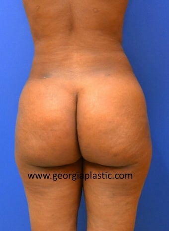 Brazilian Buttock Lift after 440724