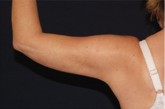 Liposuction 397170