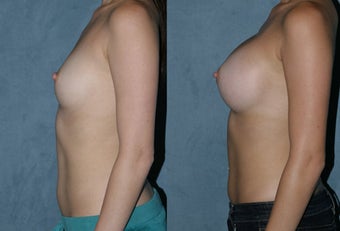 Breast Augmentation - Silicone Implants after 118037