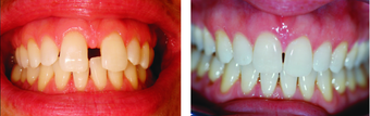 Closing large midline diastema/gap before 293393