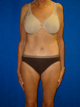Extended Tummy Tuck Surgery after 133931