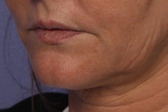 Perlane L to Lips before 309740