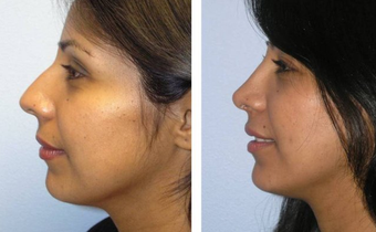 Rhinoplasty before 161407