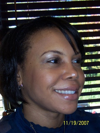Rhinoplasty 368023