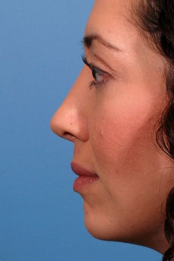 Rhinoplasty after 91601