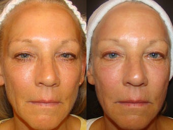 Ultherapy before 529422