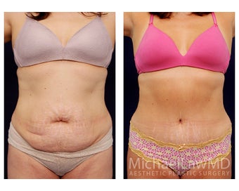Tummy Tuck with Liposuction before 391594