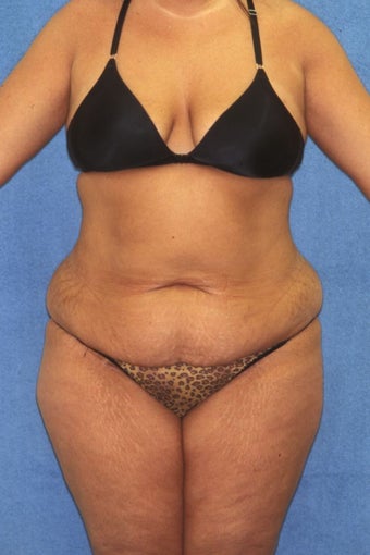Tummy Tuck with Liposuction before 411595