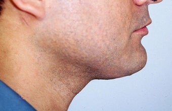 Neck liposuction after 68525