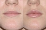 Lip Augmentation before 596221