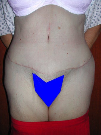 Extended Tummy Tuck after 119745